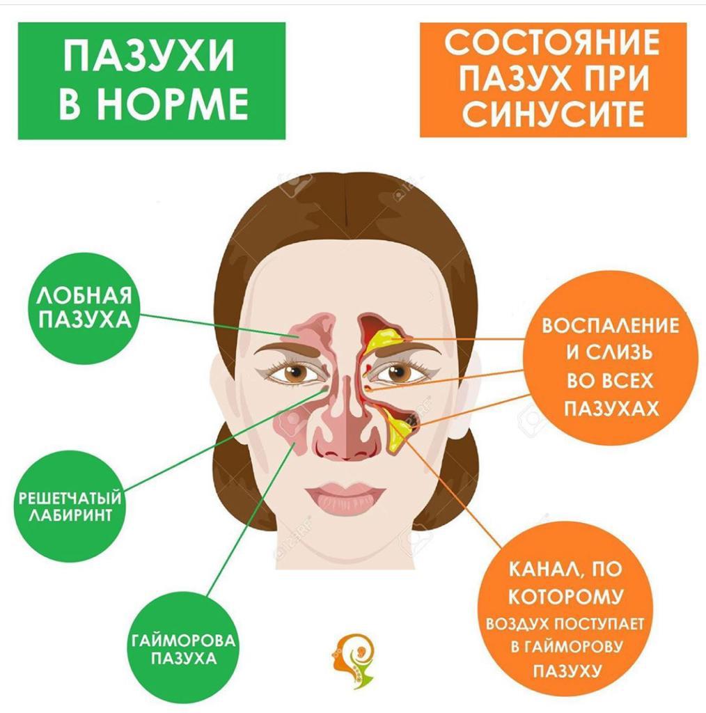 Опухоли полости носа и околоносовых пазух
