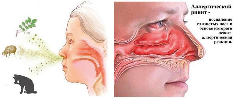 Заложенность носа: причины и последствия